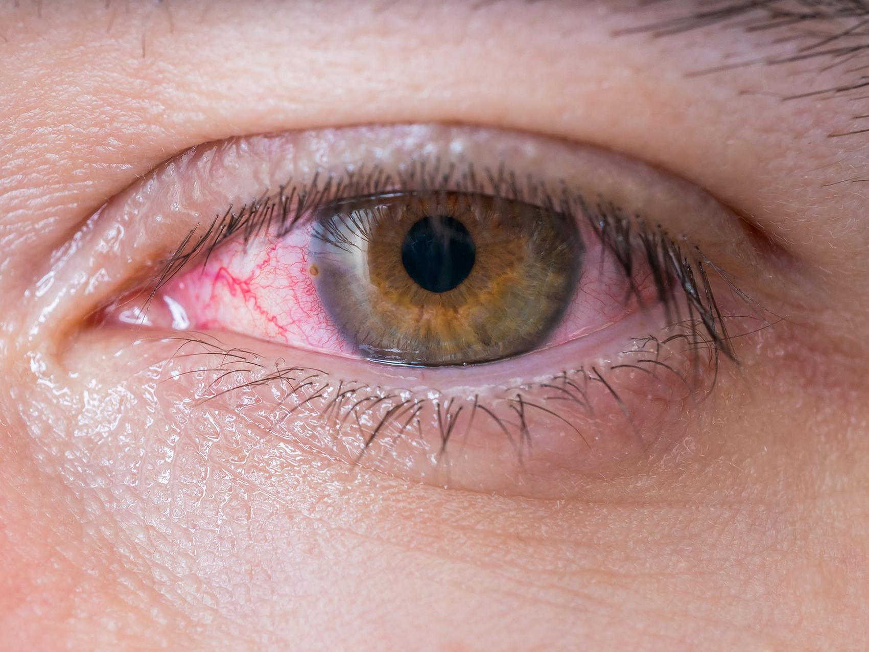 The image shows a close-up of an unhealthy eye, illustrating the appearance of potential eye hazards. 