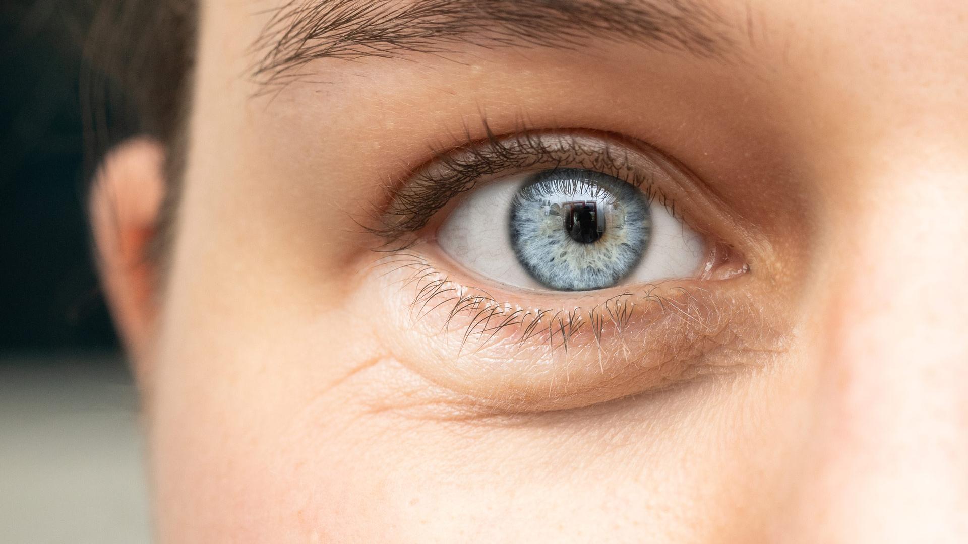 Olhos inchados, olheiras, olhos vermelhos e ardor nos olhos