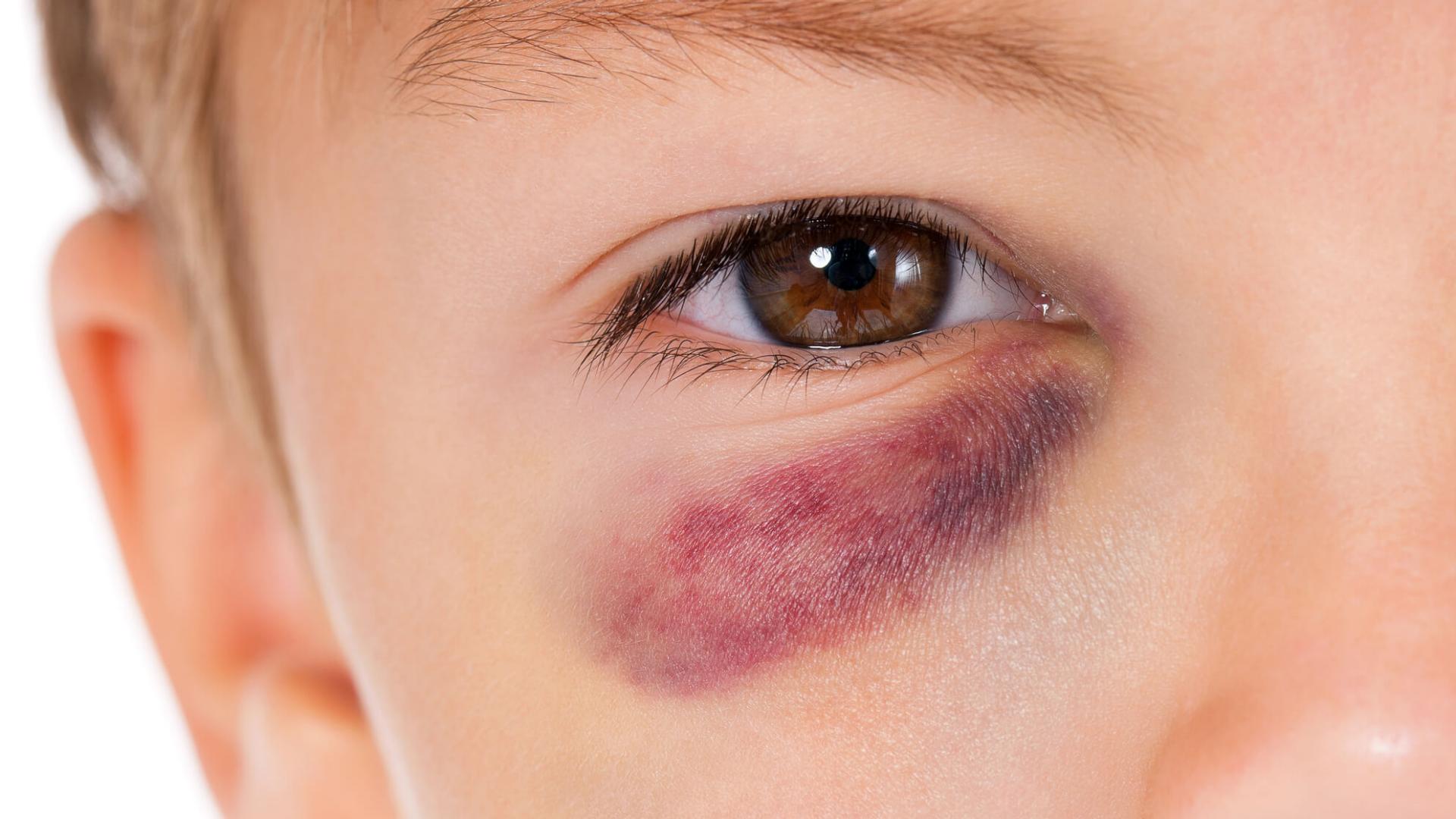 O que é um olho roxo, quanto tempo dura e quais são as causas?