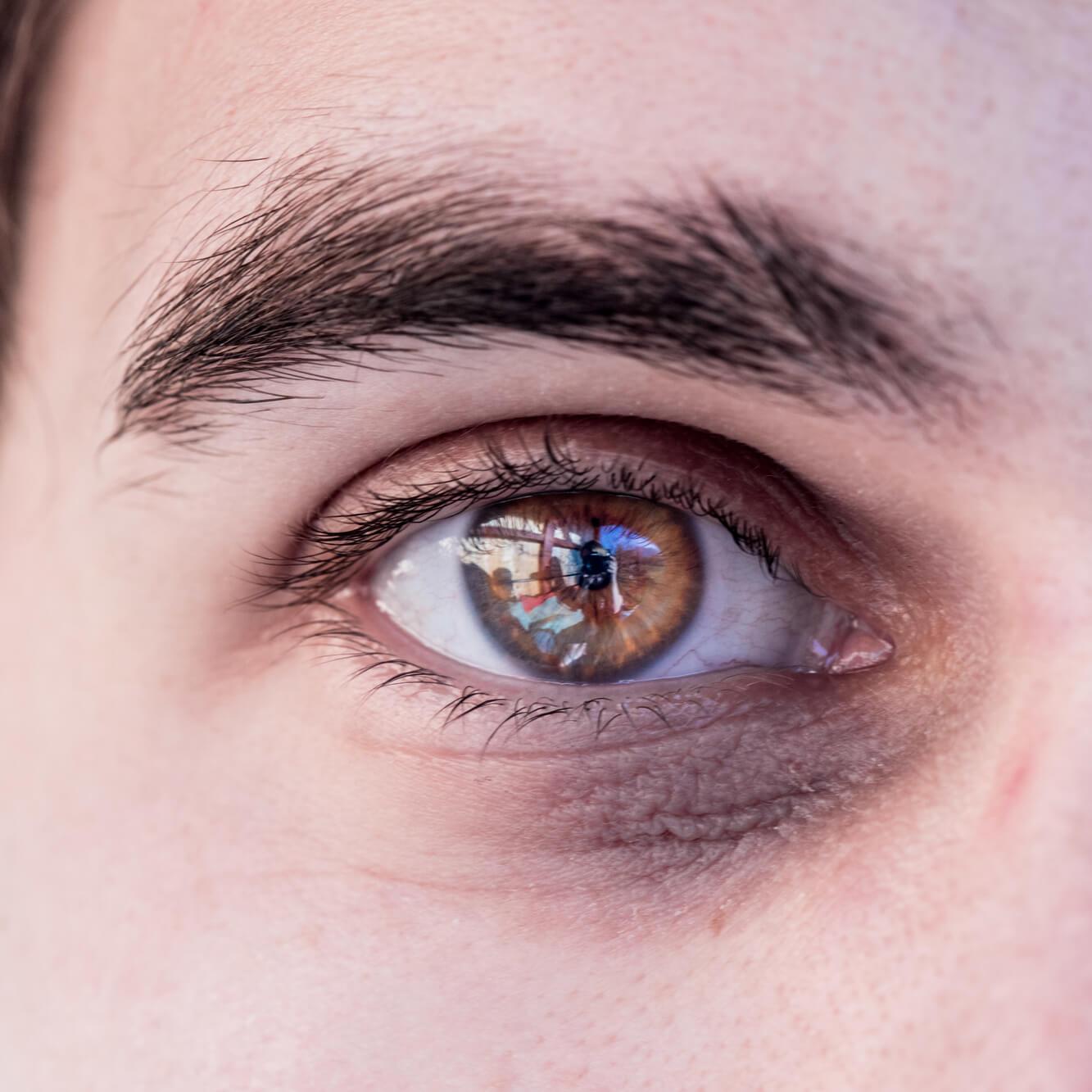 O aparecimento de papos nos olhos pode ser agravado pela falta de sono, a alimentação, o stress e o estilo de vida.
