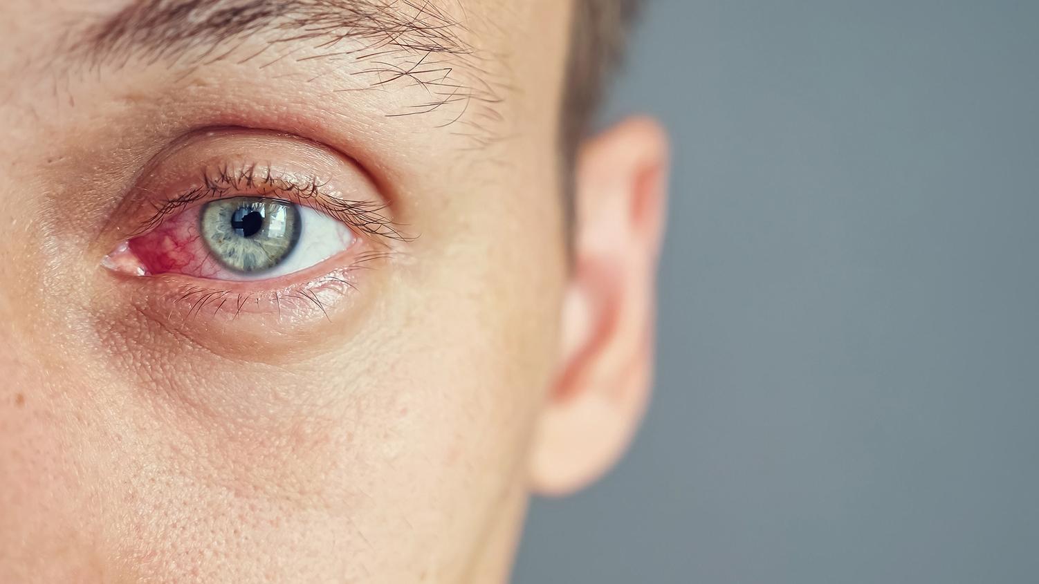 Inflamação ocular