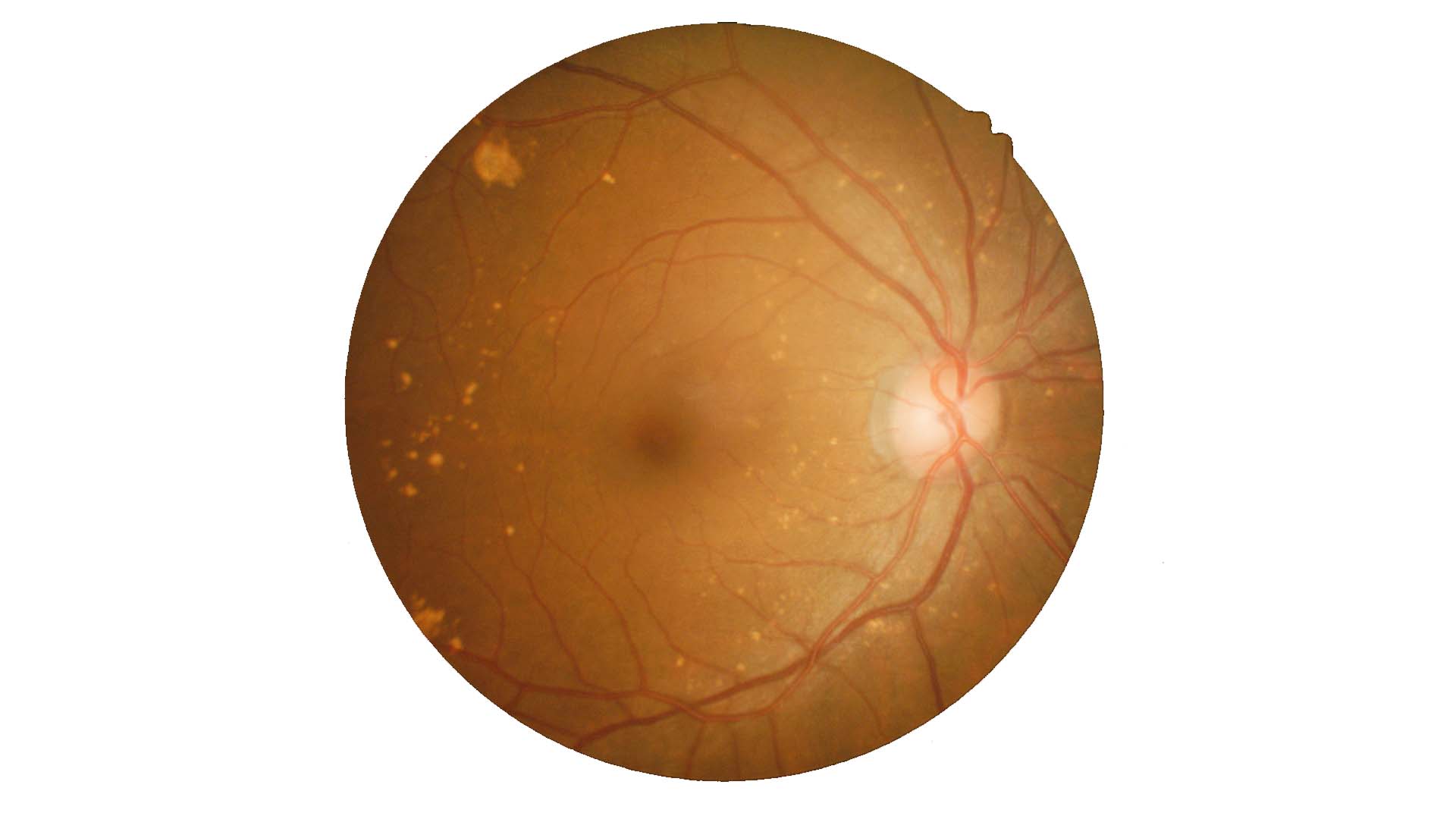 Lesões na retina