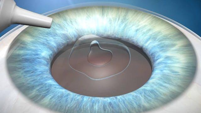 Anestesia