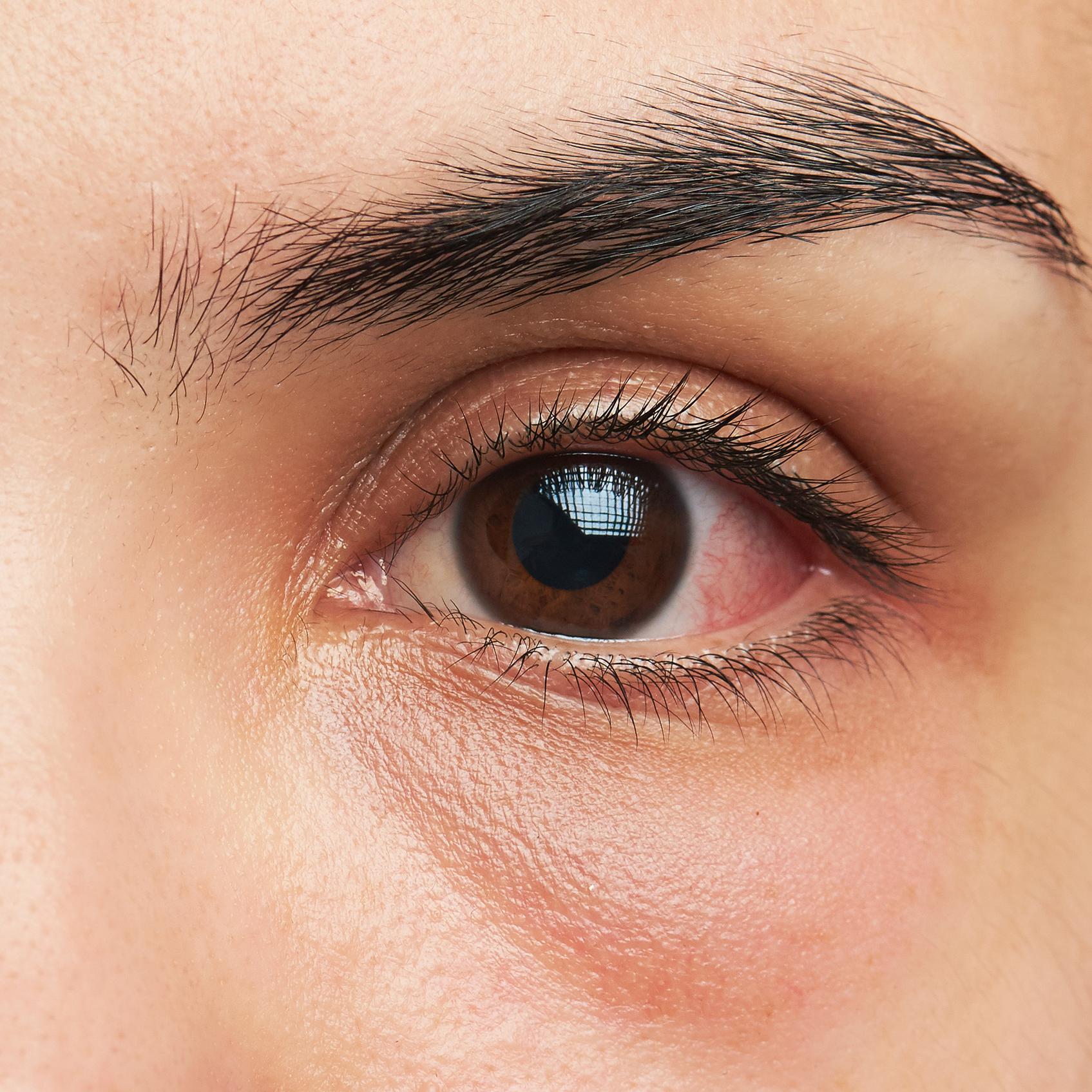 Infecção ocular, infecção