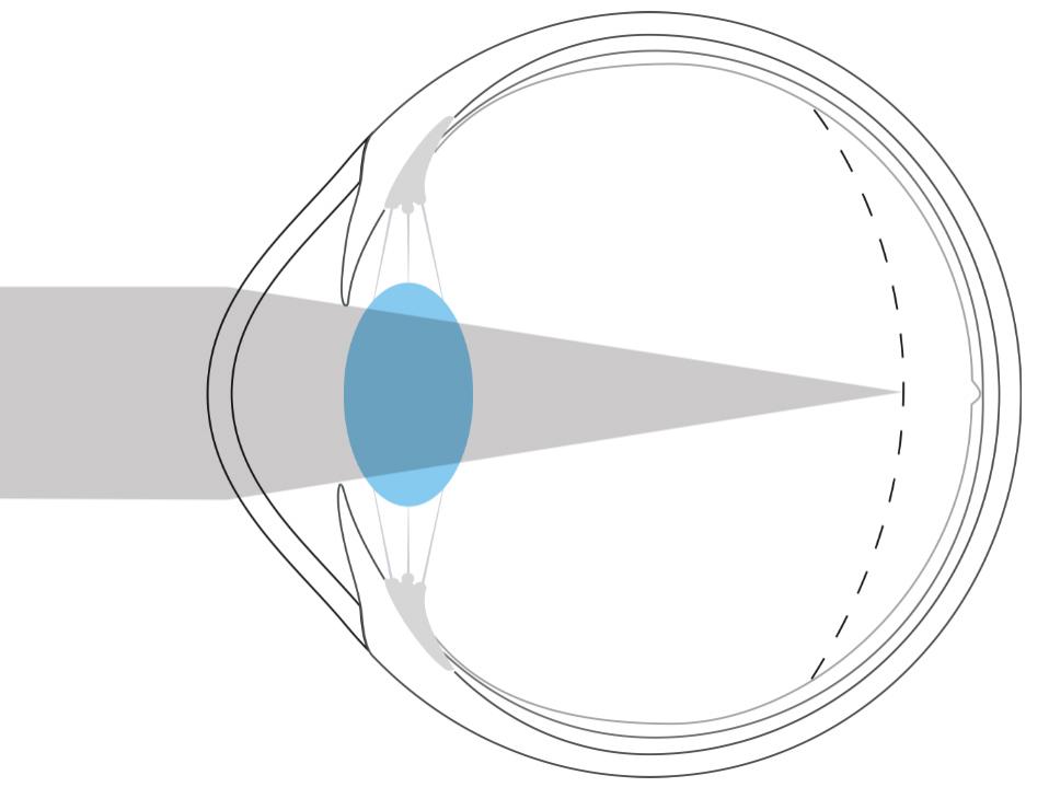 Ilustração de um olho míope que mostra a luz a ser focada à frente da retina.