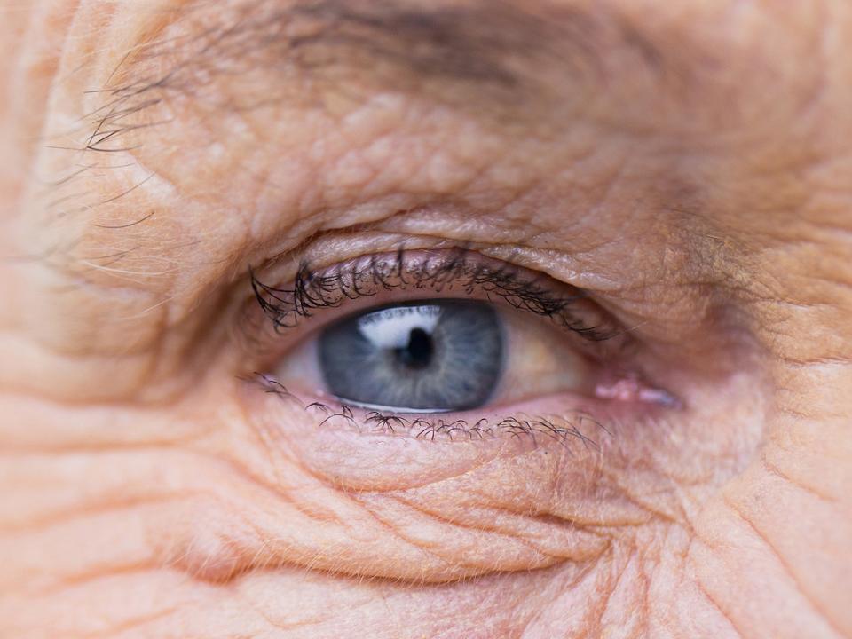 Imagem que mostra o fotoenvelhecimento à volta dos olhos.